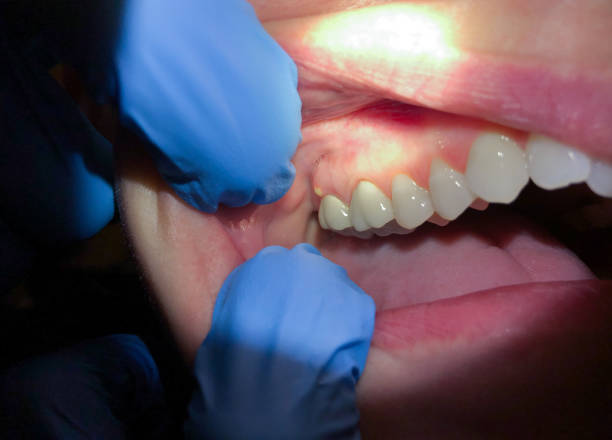 Best Emergency Treatment for Toothache in Anaconda, MT
